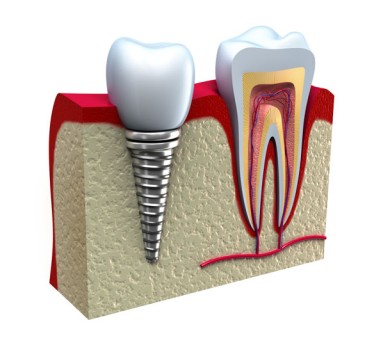 Dental Implant Surgery by OrangeCountySurgeons 